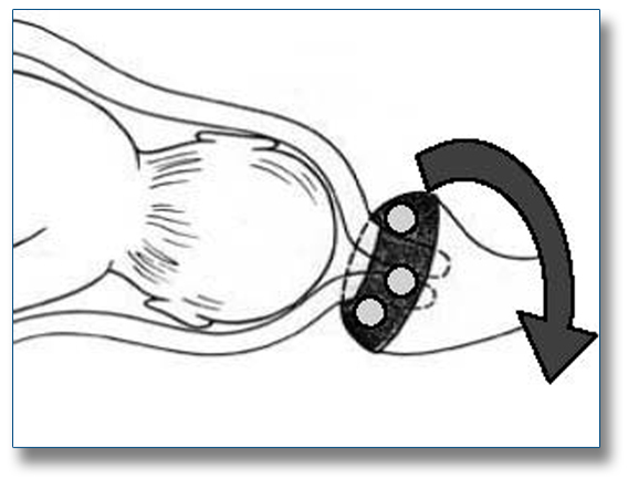 Cerclaje Pesario Perforado Dr. Arabin. Se utiliza para tratar a las mujeres embarazadas con incompetencia cervical. 
